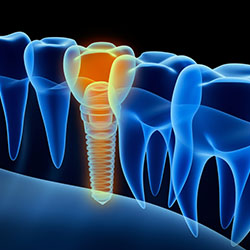 Det øjeblikkelige implantat: fakta og fordele med et øjeblik, Dentolo