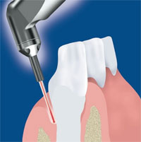 Gzfa - laser tandlæge: hvad er en laser?
