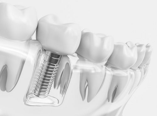Implantologi - tandlæge carina sælge