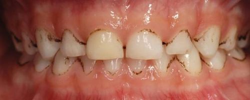 Sorte tænder (sort plet